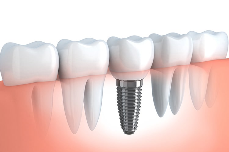 歯を失った時の3つの治療方法について